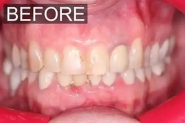 Dental Veneers before at Dental Works in Scottsdale, AZ