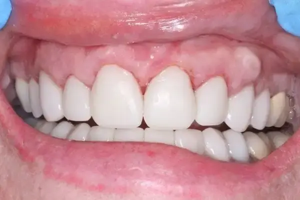 Dental Works gum reshaping after — Scottsdale, AZ