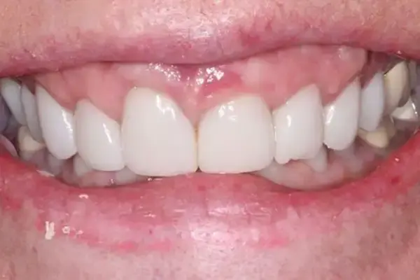 Gum Contouring before at Dental Works in Scottsdale, AZ