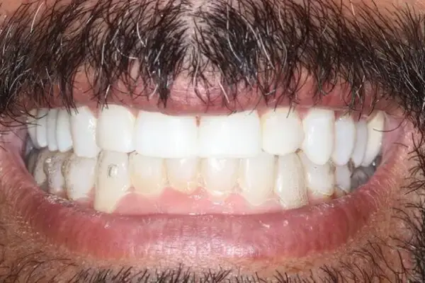 Dental Works invisalign after — Scottsdale, AZ