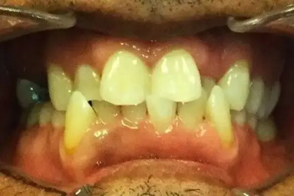 Invisalign before at Dental Works in Scottsdale, AZ