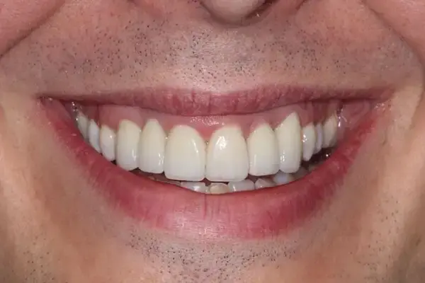 Dental Works dental implants after — Scottsdale, AZ