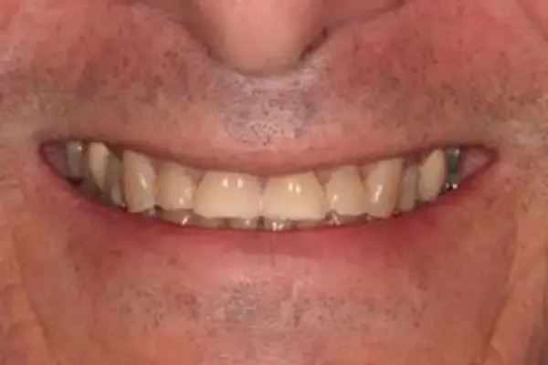 Dental Veneers before at Dental Works in Scottsdale, AZ