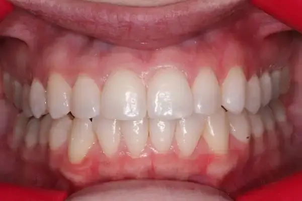 Dental Works invisalign after — Scottsdale, AZ