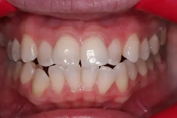 Invisalign before at Dental Works in Scottsdale, AZ