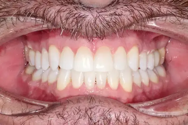 Dental Works invisalign after — Scottsdale, AZ