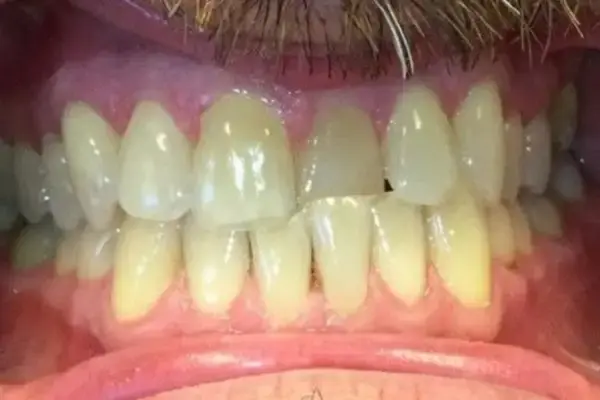 Invisalign before at Dental Works in Scottsdale, AZ