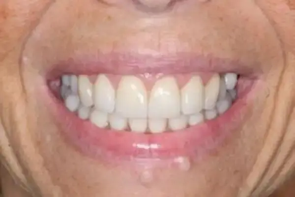 Dental Works dental crowns after — Scottsdale, AZ
