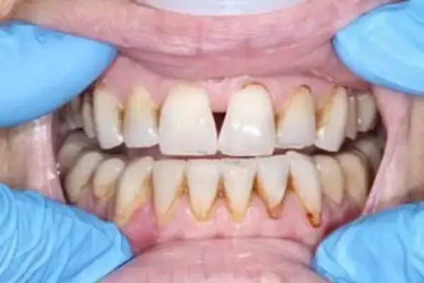 Dental Crowns before at Dental Works in Scottsdale, AZ