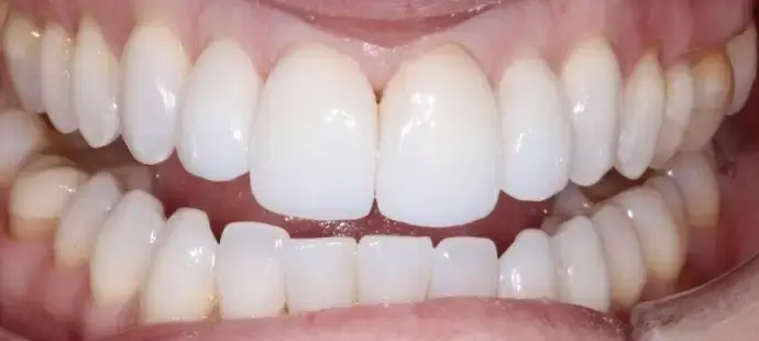 Dental Works veneers after — Scottsdale, AZ