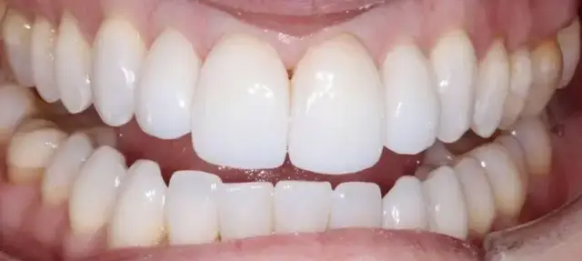 Dental Veneers after at Dental Works in Scottsdale, AZ