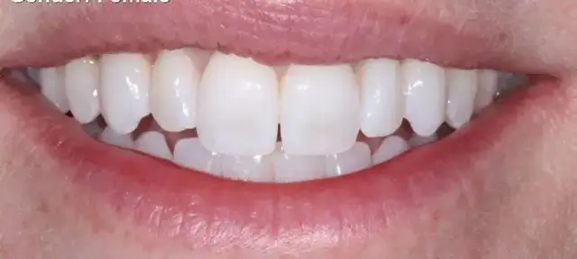 Dental Veneers before at Dental Works in Scottsdale, AZ