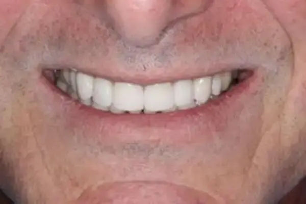 Dental Crowns after at Dental Works in Scottsdale, AZ