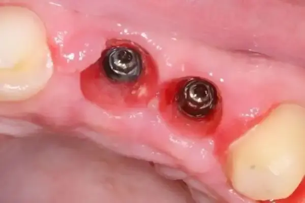 Dental Implants before at Dental Works in Scottsdale, AZ