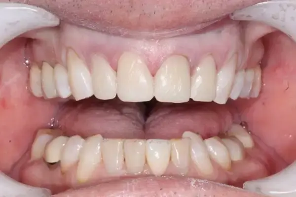 Dental Works smile makeover after — Scottsdale, AZ