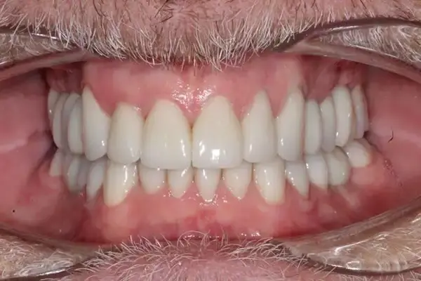 Dental Works smile makeover after — Scottsdale, AZ