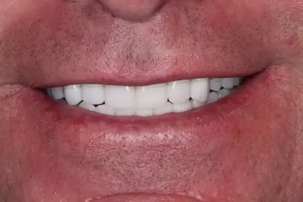 Dental Works smile makeover after — Scottsdale, AZ