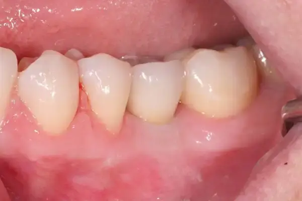 Dental Works dental implants after — Scottsdale, AZ