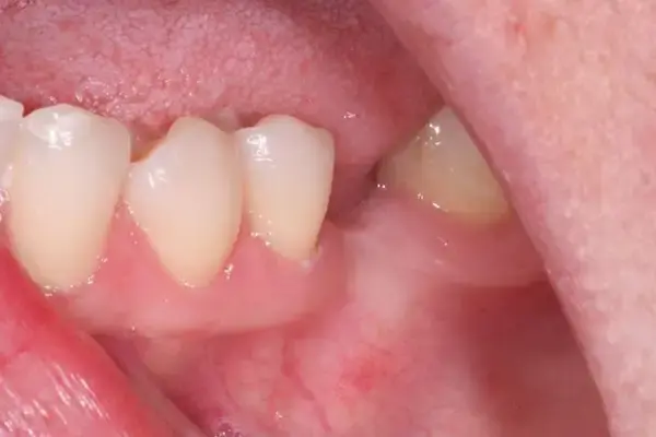 Dental Implants before at Dental Works in Scottsdale, AZ