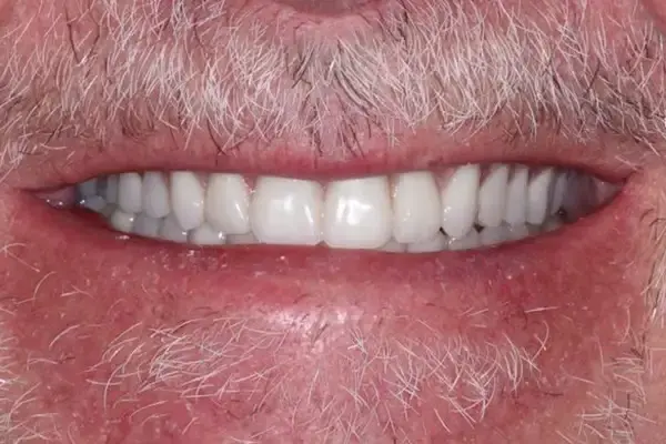 Dental Works smile makeover after — Scottsdale, AZ