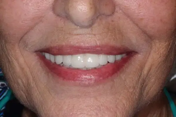 Dental Works dental implants after — Scottsdale, AZ