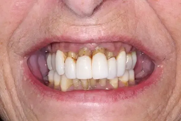 Dental Implants before at Dental Works in Scottsdale, AZ