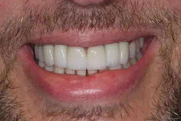 Dental Crowns after at Dental Works in Scottsdale, AZ