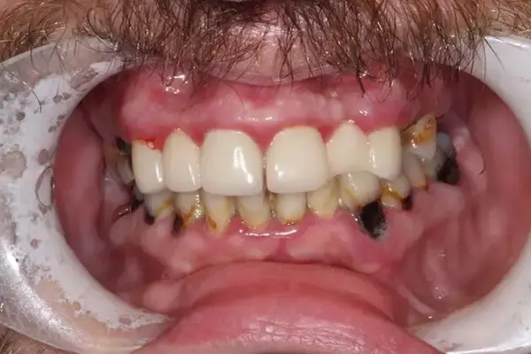 Dental Crowns before at Dental Works in Scottsdale, AZ