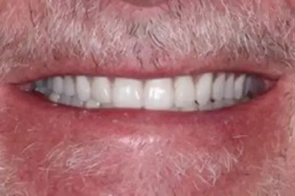Dental Works smile makeover after — Scottsdale, AZ