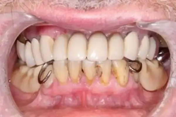 Smile Makeover before at Dental Works in Scottsdale, AZ