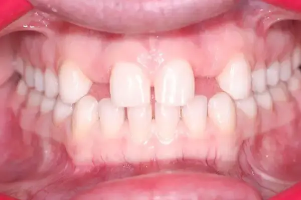 Dental Implants before at Dental Works in Scottsdale, AZ
