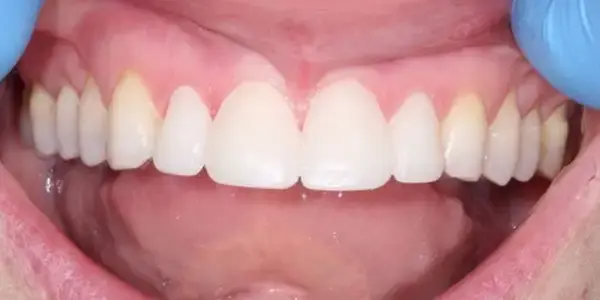 Dental Works smile makeover after — Scottsdale, AZ