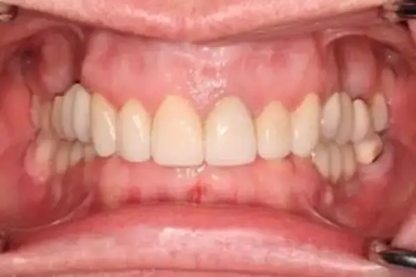 Dental Crowns after at Dental Works in Scottsdale, AZ