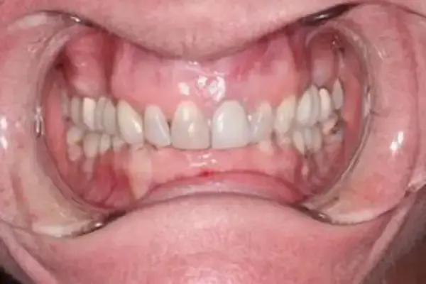Dental Crowns before at Dental Works in Scottsdale, AZ