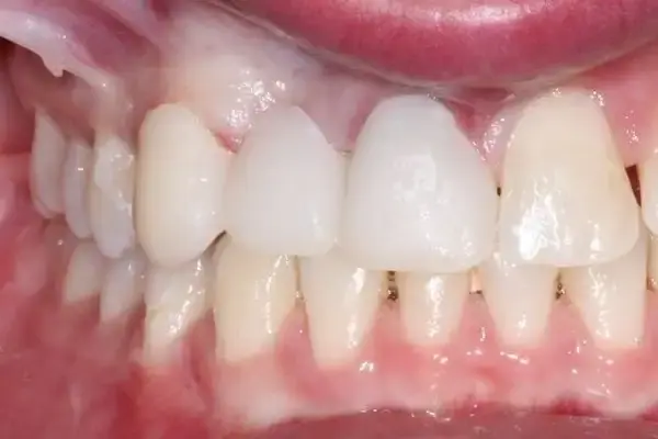 Dental Works smile makeover after — Scottsdale, AZ