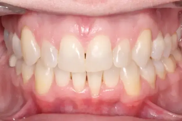 Dental Works invisalign after — Scottsdale, AZ