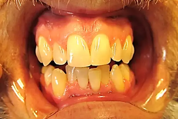 Invisalign before at Dental Works in Scottsdale, AZ