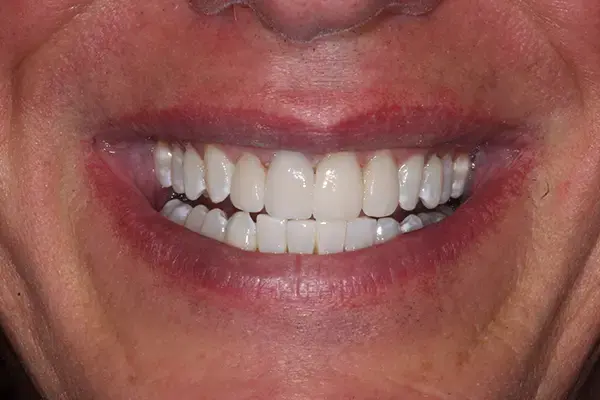 Dental Crowns after at Dental Works in Scottsdale, AZ