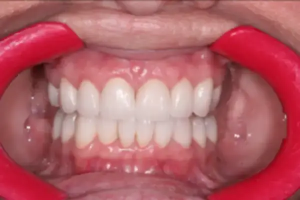 Dental Veneers after at Dental Works in Scottsdale, AZ