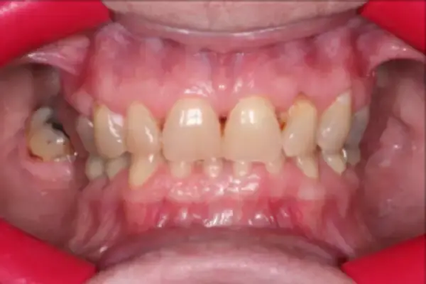 Dental Veneers before at Dental Works in Scottsdale, AZ