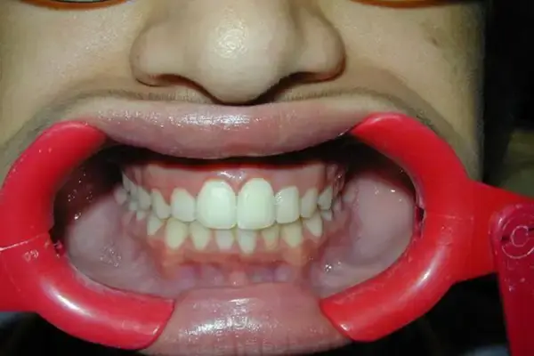 Dental Works smile makeover after — Scottsdale, AZ