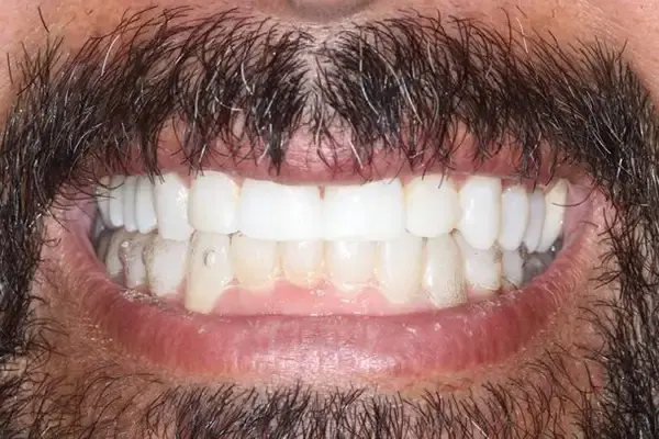 Dental Works smile makeover after — Scottsdale, AZ