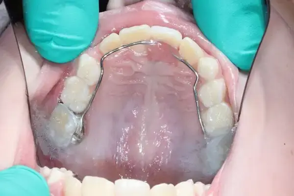 Dental Works smile makeover after — Scottsdale, AZ