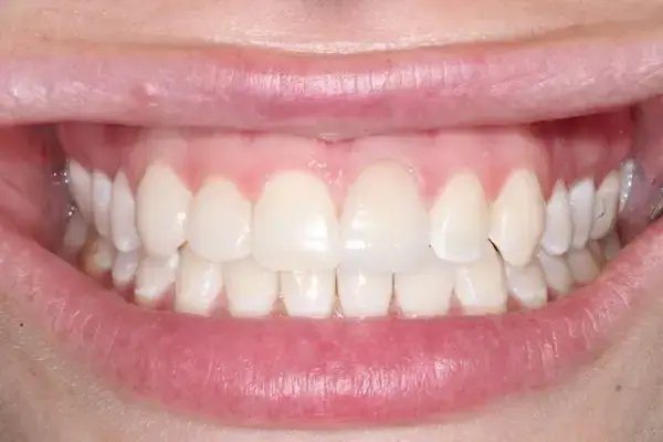 Dental Works dental crowns after — Scottsdale, AZ
