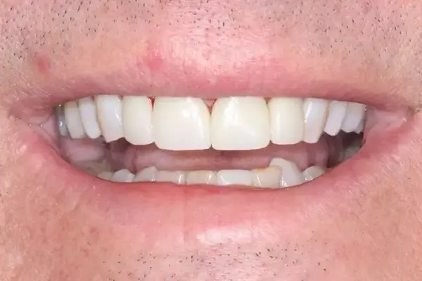 Dental Works dental crowns after — Scottsdale, AZ