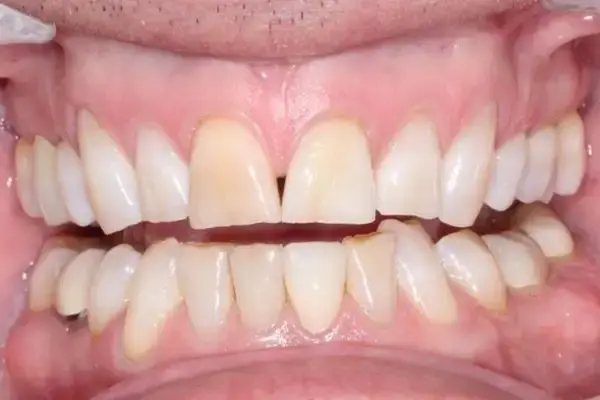 Dental Crowns before at Dental Works in Scottsdale, AZ