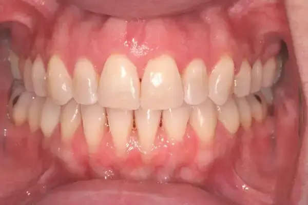 Dental Works invisalign after — Scottsdale, AZ