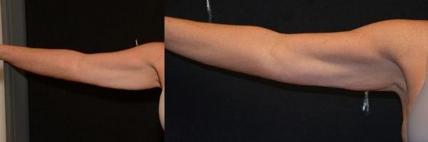 Body By Bloch (Steven Bloch, MD) arm lift result — Highland Park, IL