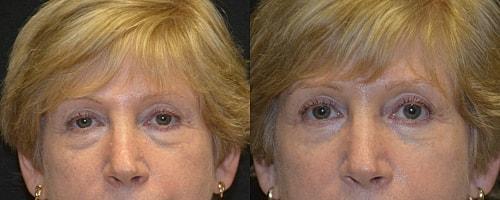 Body By Bloch (Steven Bloch, MD) eyelid lift result — Highland Park, IL