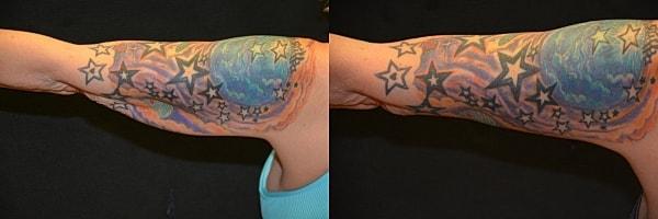 Body By Bloch (Steven Bloch, MD) arm lift result — Highland Park, IL